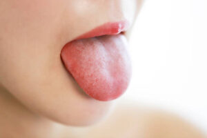 舌が白い人は必見!舌苔の原因と除去の方法を歯医者が徹底解説【前編】