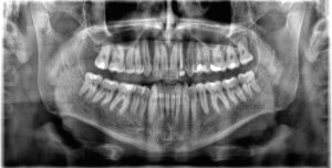 歯列矯正で歯が動きやすいのはどんな人｜歯が動かない「アンキローシス」って何？